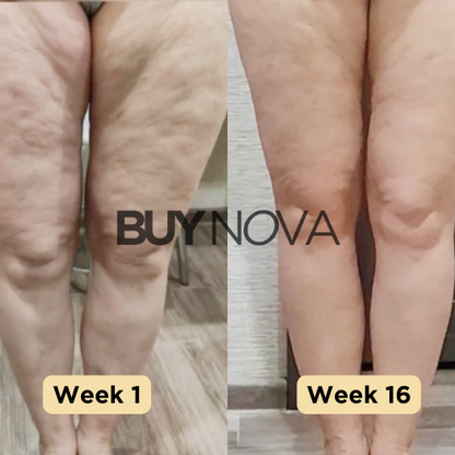 NovaLite - Appareil Anti-Cellulite pour une Peau Parfaite