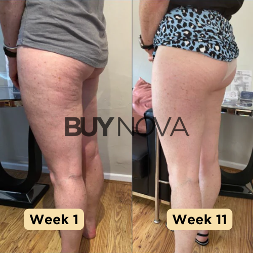 NovaLite - Appareil Anti-Cellulite pour une Peau Parfaite