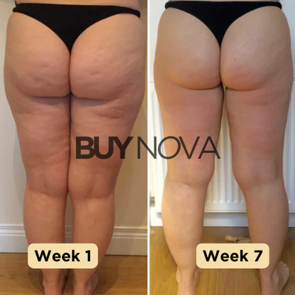 NovaLite - Appareil Anti-Cellulite pour une Peau Parfaite